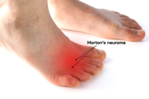 Morton&#039;s Neuroma and Surgical Relief