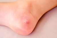 Children's Foot Blisters and Prevention Tips